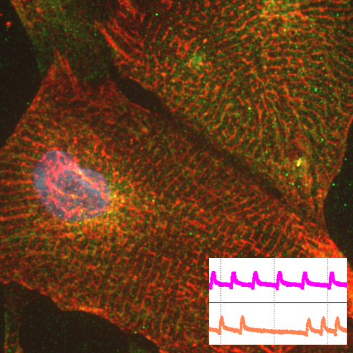 Stem cell-derived cardiomyocyte from a patient with dilated cardiomyopathy showing arrhythmias in beating